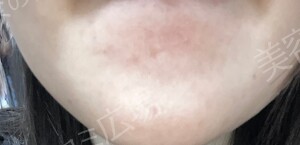 治療直後の症例写真