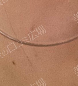 治療直後の症例写真