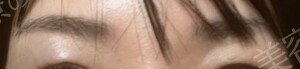 治療直後の症例写真