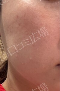 顔脱毛1回｜新宿院：ジェントルマックスプロプラスの治療前の症例写真