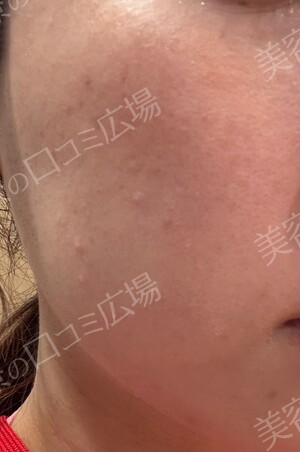新宿ラクル美容外科クリニックの医療脱毛の症例写真[ビフォー]