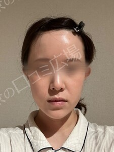 貴族手術（鼻翼基部プロテーゼ）｜ほうれい線を改善の治療結果の症例写真