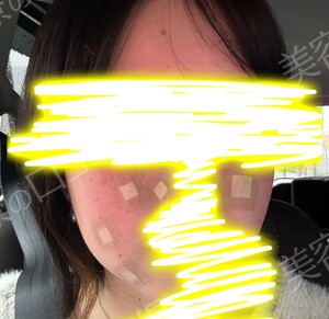 治療直後の症例写真