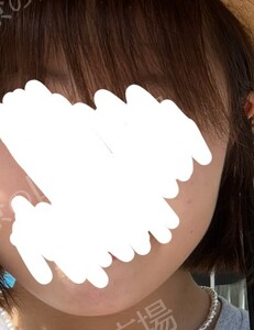 治療結果の症例写真