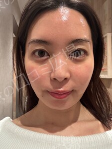 治療直後の症例写真