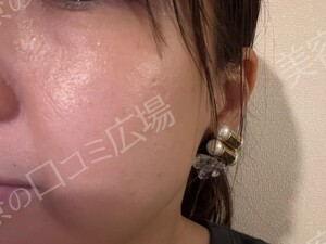 治療直後の症例写真