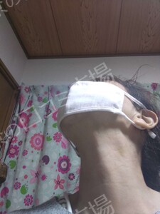 治療直後の症例写真