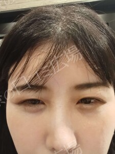 【おすすめ！】　涙袋ヒアルロン酸（0.1㏄）の治療結果の症例写真