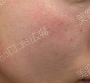 治療直後の症例写真