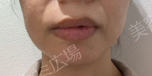 さっぽろ美容クリニック 本院の輪郭形成の症例写真[ビフォー]