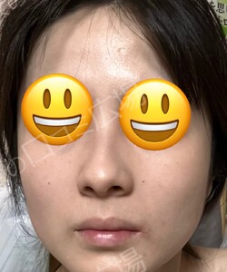 治療直後の症例写真