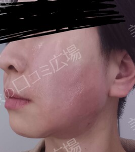 治療直後の症例写真