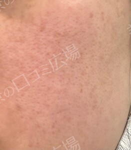 治療前の症例写真