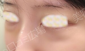 治療直後の症例写真