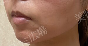 治療直後の症例写真
