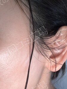 治療前の症例写真