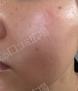 【高崎院限定】初回限定：無料✨｜ピコトーニング｜全顔1回の治療前の症例写真