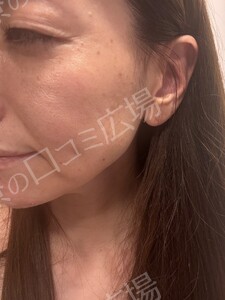 【初回｜平日限定】高出力！ルメッカ2周｜透明感あるお肌に🌿の治療直後の症例写真