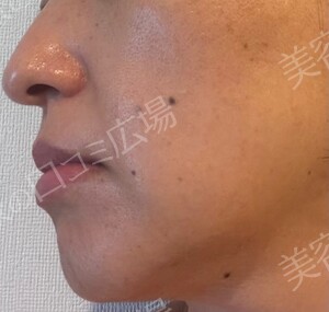 治療直後の症例写真