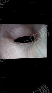 治療直後の症例写真