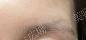 【口コミ広場期間限定価格】韓国製ボトックス｜1部位の治療直後の症例写真