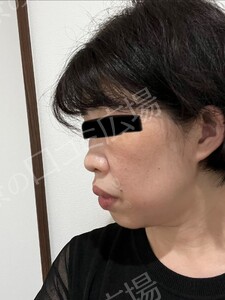 治療直後の症例写真