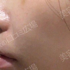新宿ラクル美容外科クリニックのシミ取り・肝斑・毛穴治療の症例写真[ビフォー]