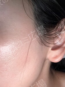 治療直後の症例写真