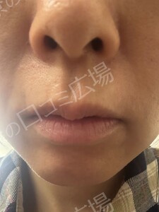 リップ ＆ アイライン上下 アートメイク 2回 モニター施術の治療前の症例写真