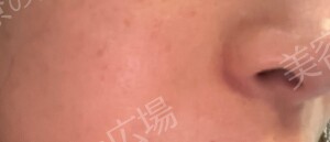 治療直後の症例写真