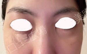 治療直後の症例写真