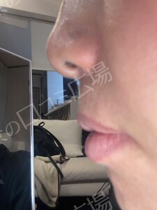 治療直後の症例写真