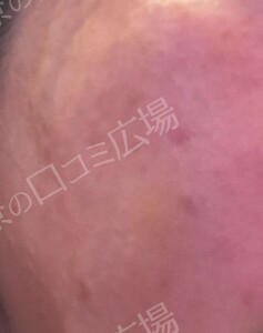 治療直後の症例写真