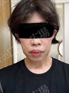 治療直後の症例写真