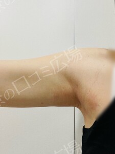 治療直後の症例写真