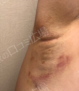 治療直後の症例写真