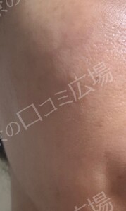 治療直後の症例写真