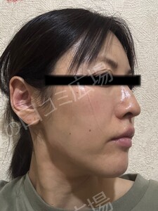 治療直後の症例写真