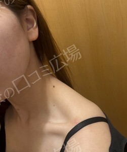 治療直後の症例写真