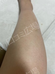 治療結果の症例写真