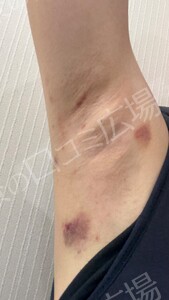 治療直後の症例写真