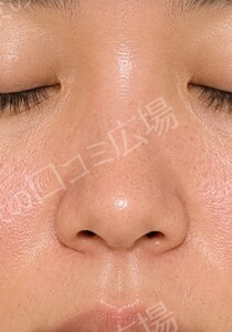 治療直後の症例写真