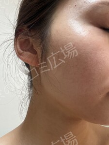 ジェネシスの治療結果の症例写真