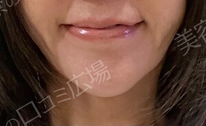 治療直後の症例写真