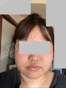 治療前の症例写真