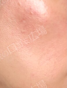 治療前の症例写真