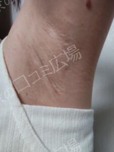 ミラドライ 両わき 1回 レベル８＋部分重複照射の治療結果の症例写真