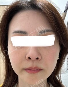 治療直後の症例写真
