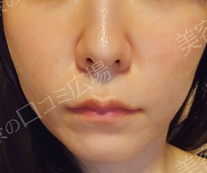 治療直後の症例写真
