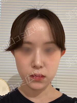 新宿ラクル美容外科クリニックの鼻の整形の症例写真[ビフォー]